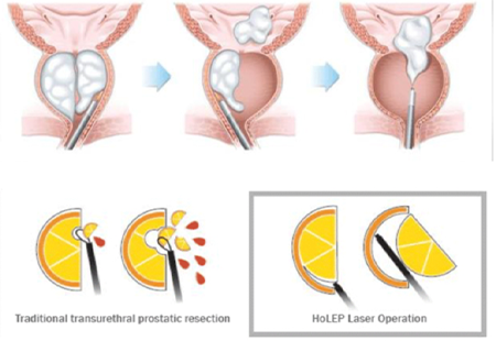 The History Of Prostate Enucleation Didusch Museum